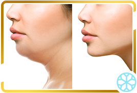 Radiofrequency for Facial Skin Tightening  in Chicago, IL