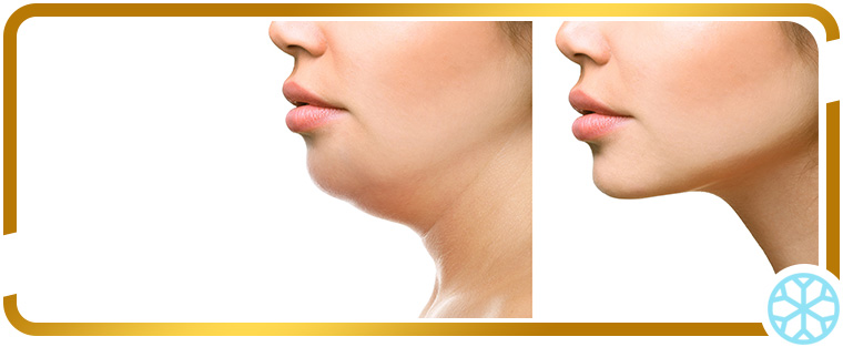 Radiofrequency for Facial Skin Tightening in Chicago, IL