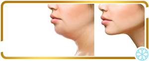 Radiofrequency for Facial Skin Tightening Services in Chicago, IL